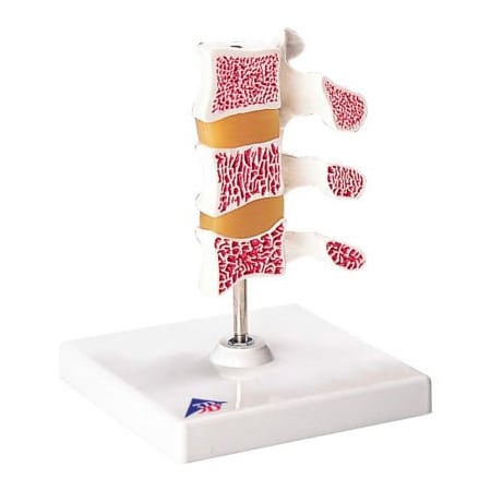Fabrication Enterprises 3B Anatomical Model - Deluxe Osteoporosis (3 Vertebrae) 1062096
